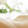 Back with acupuncture needles pricked by a Perth Chiropractor