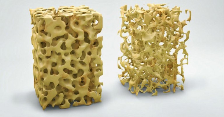 bone density