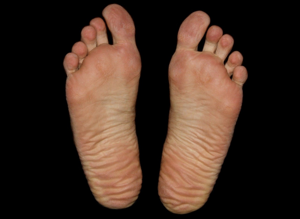 skin-peeling-between-toes-causes-and-natural-treatments